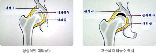 무혈성괴사 Avascular Necrosis