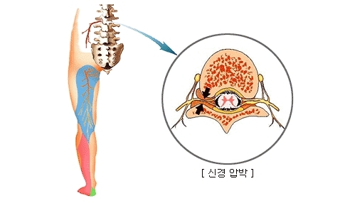 좌골 신경통