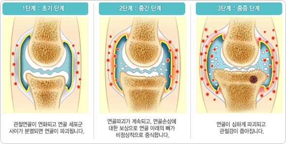 무릎관절염