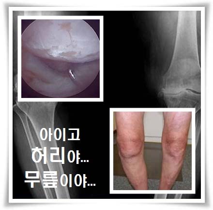 류마티스 관절염