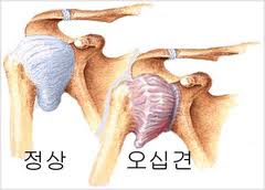 오십견